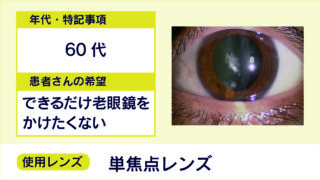 【白内障手術 症例2】60代/単焦点レンズ